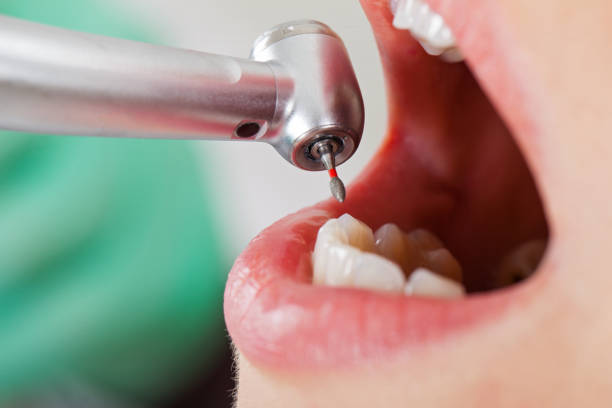 Best Emergency Wisdom Teeth Removal in Powell, TN
